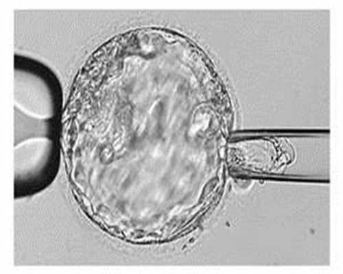 武汉代孕官网,卵巢癌患者的饮食指南 卵巢癌饮食